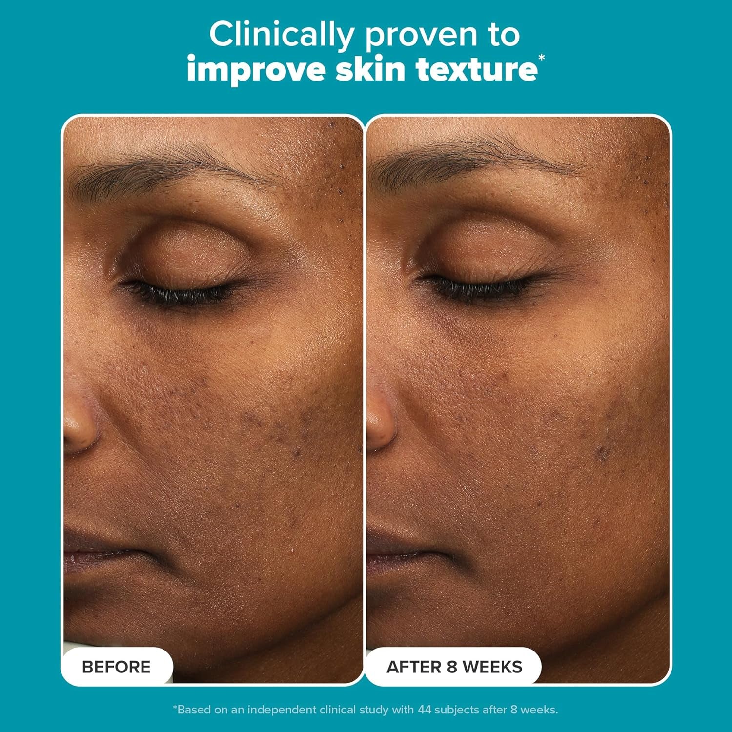 Paula’S Choice 6% Mandelic Acid + 2% Lactic Acid Exfoliant, Gentle Daily AHA Exfoliant, Face Exfoliator for Discoloration, Bumpy Texture & Radiance, for Sensitive Skin, Fragrance-Free